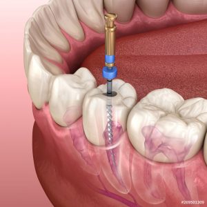 emergency-root-canal-treatment