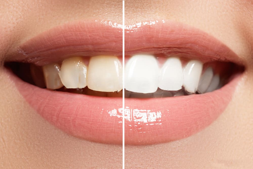 teeth-whitening-canberra
